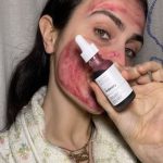 کاربردهای سرم ضدجوش اوردینری قرمز