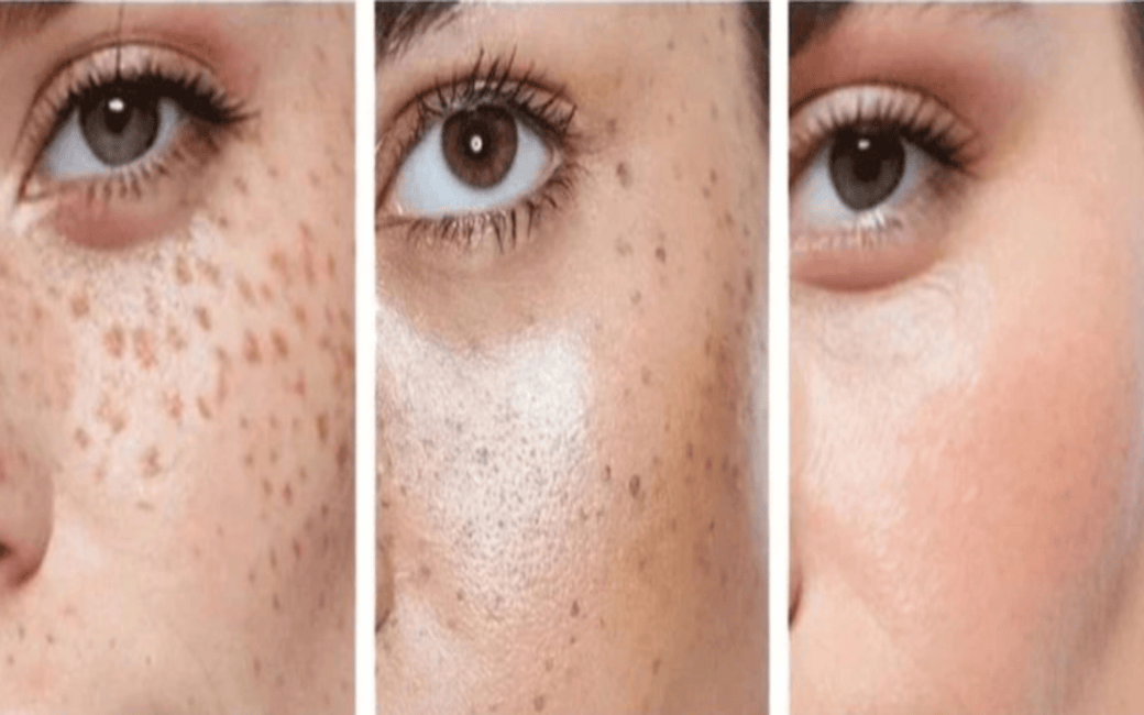 بهترین روش پیشگیری از لک صورت چیست؟