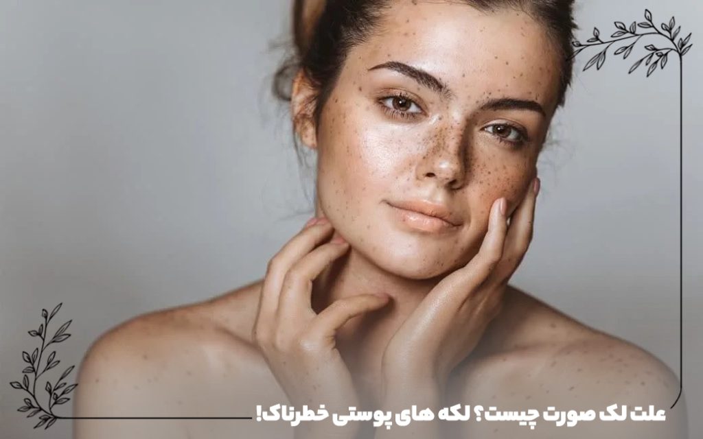 علت لک صورت چیست؟ لکه های پوستی خطرناک!