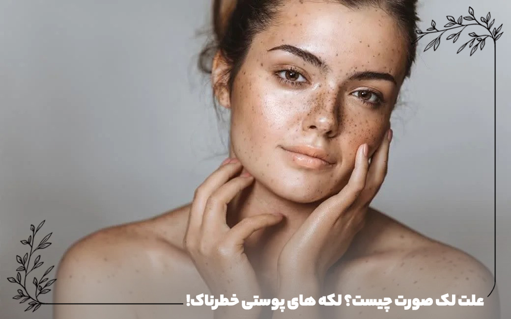 علت لک صورت چیست؟ لکه های پوستی خطرناک!