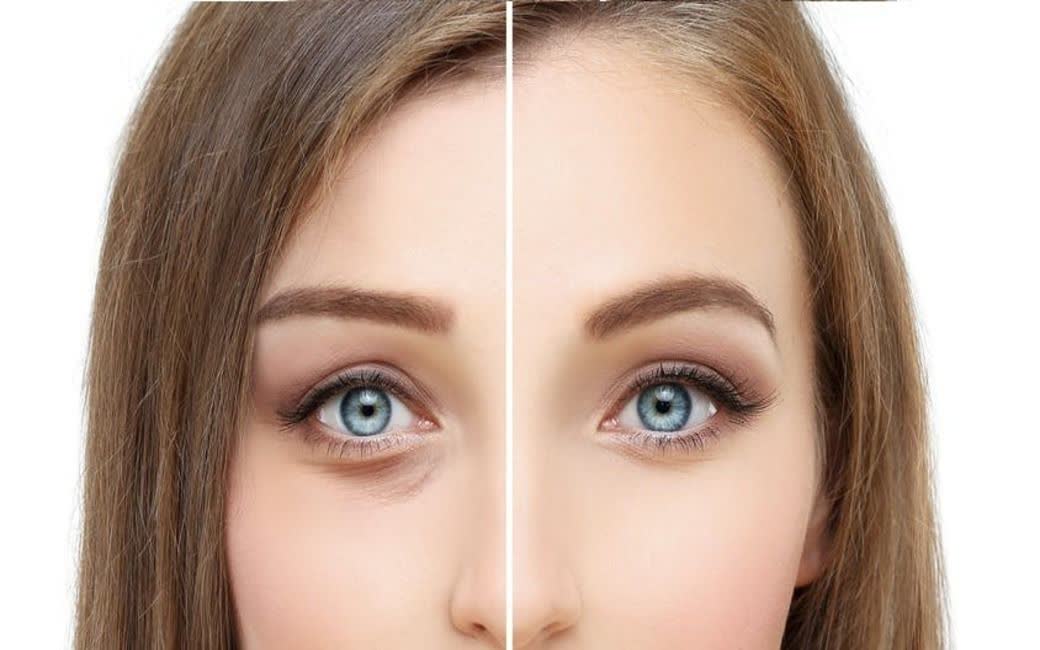جراحی پلک چیست؟