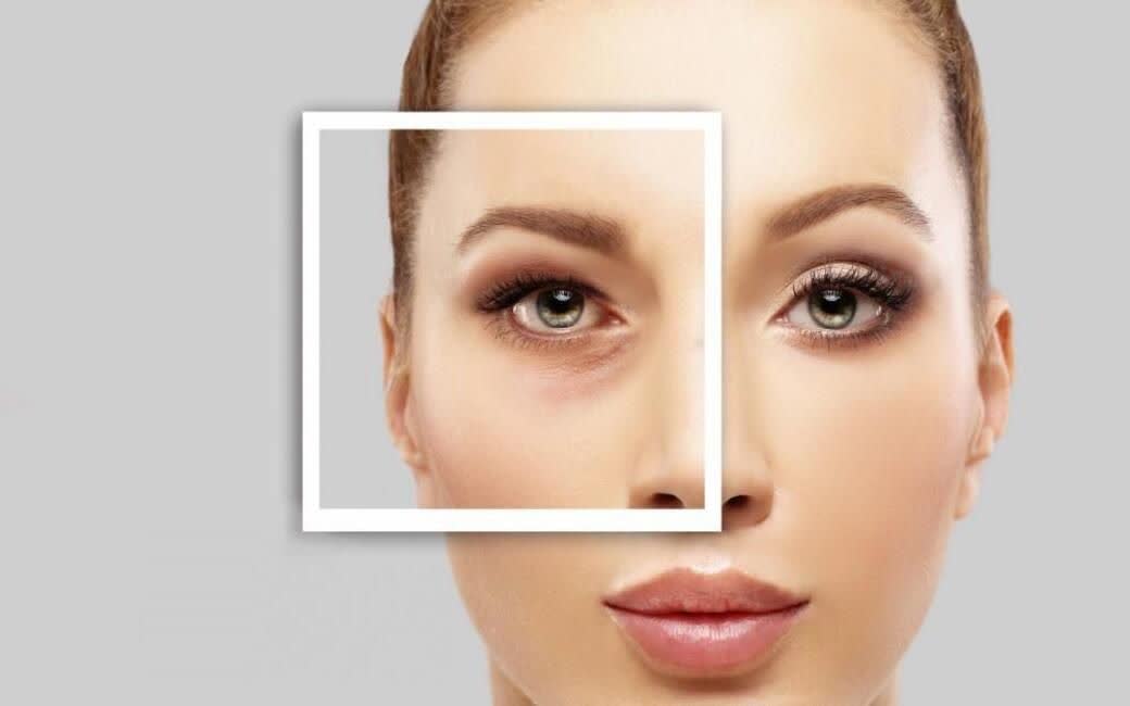 مزایای بلفاروپلاستی چیست؟