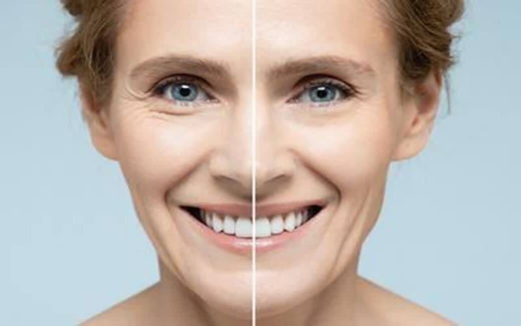روش های درمان چروک زیر چشم